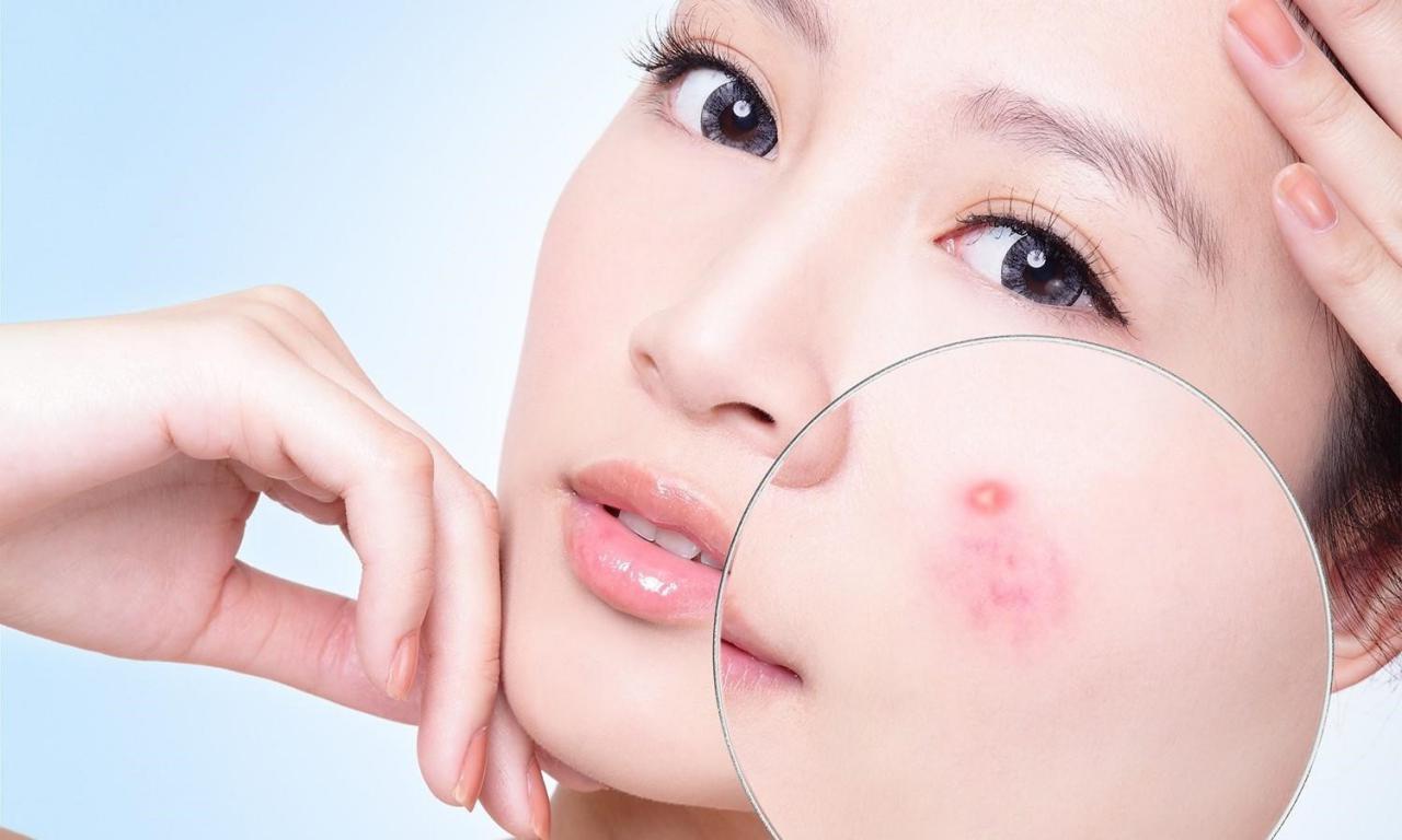 Hướng dẫn cách chăm sóc da mặt bị mụn hiệu quả vào mùa hè